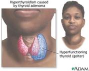 http://www.nlm.nih.gov/medlineplus/ency/images/ency/fullsize/17071.jpg