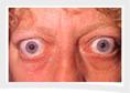 http://www.visitech.org/gifs/thyroid-eye.jpg
