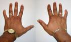 bent little finger.jpg